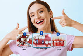 Dental Implants: The Complete Guide to a Confident Smile