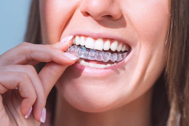 Affordable Invisalign: Tips to Save on Your Smile Makeover